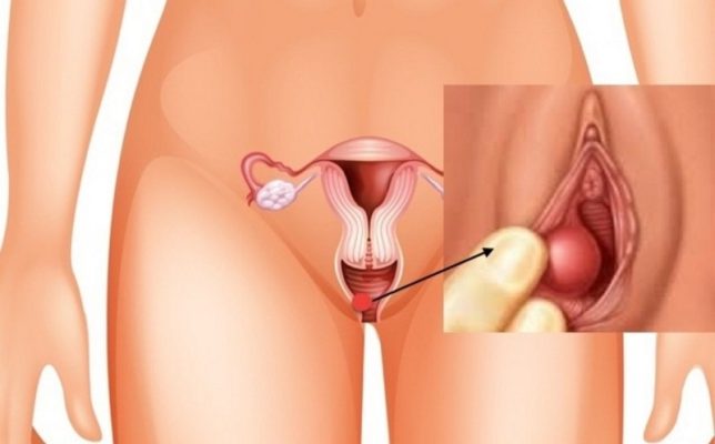 U nang tuyến Bartholin