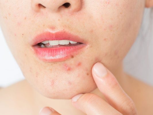 Thảo dược chữa trị mụn nội tiết